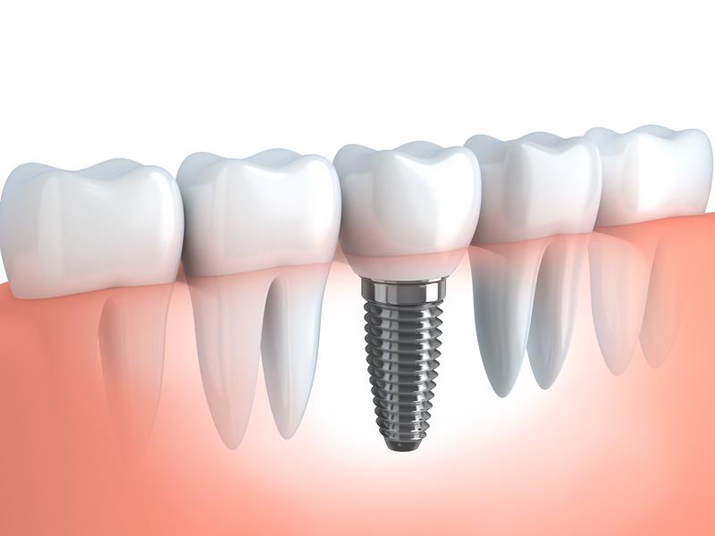 Dental Implants Baltimore, MD 