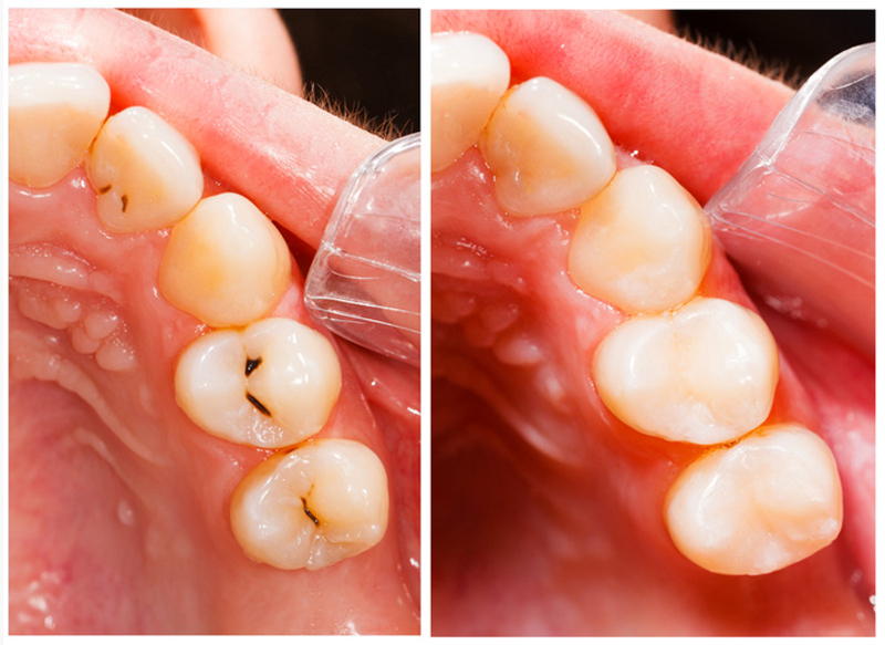 Fillings Baltimore, MD