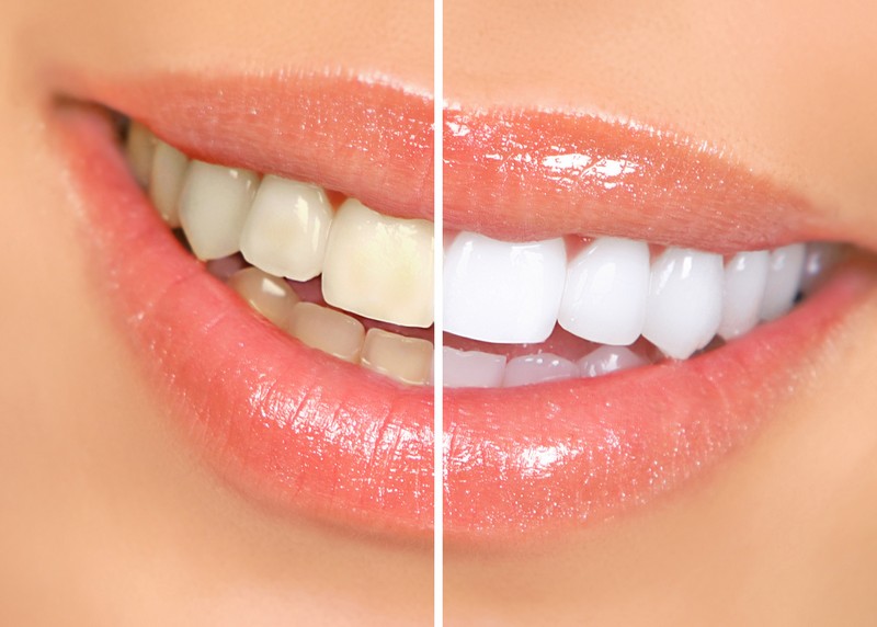Teeth Whitening Baltimore, MD