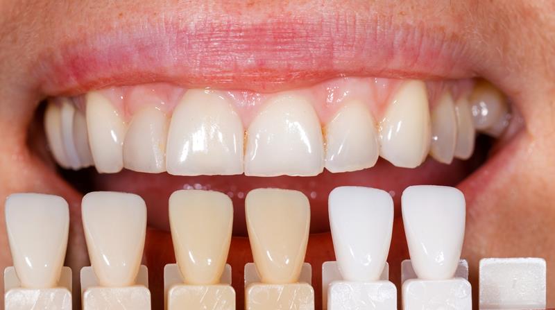 Veneers Baltimore, MD